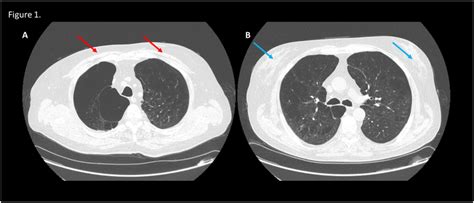 Computed Tomography Of The Chest Without Intravenous Contrast Images