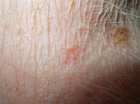 Image Gallery Primary Skin Lesions Clinicians Brief