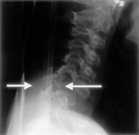 Plain Radiograph Of The Cervical Spine Demonstrating The Collapse Of C7
