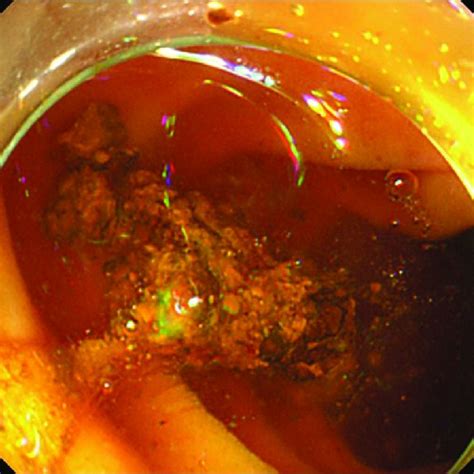 Endoscopic Views Of Common Bile Duct Cbd Stone Removal By Using Only
