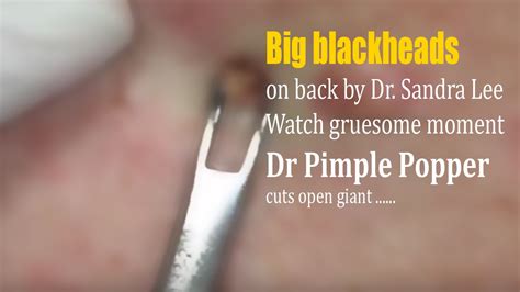 Big Blackheads On Back By Dr Sandra Lee Youtube