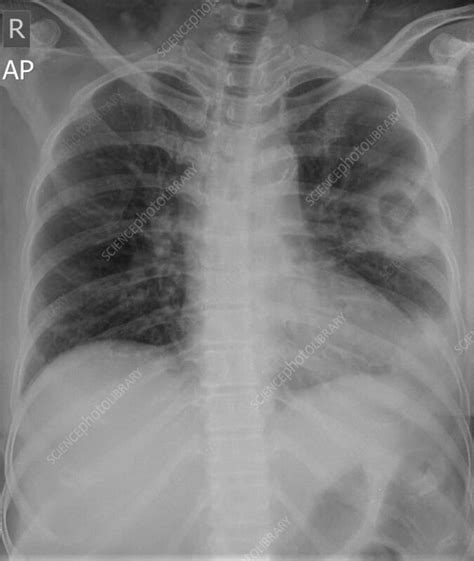 Lung Abscess X Ray Stock Image F0365533 Science Photo Library