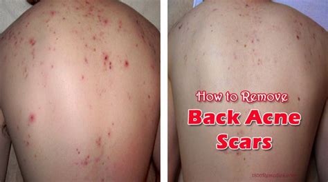 How To Remove Back Acne Scars Diy Beauty And Spa Pinterest Acne