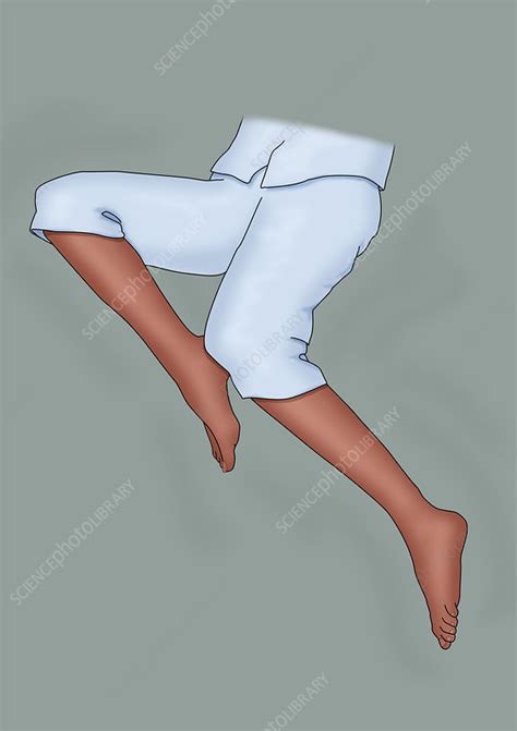 Restless Leg Syndrome Illustration Stock Image C0366303 Science Photo Library