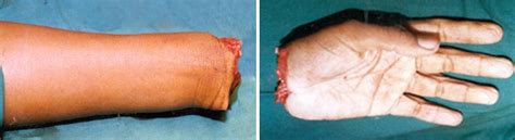 Replantation Hand Orthobullets