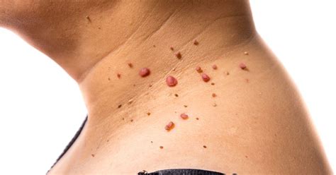 How to remove warts on dogs. How to Remove Annoying Papillomas and Warts Once For All