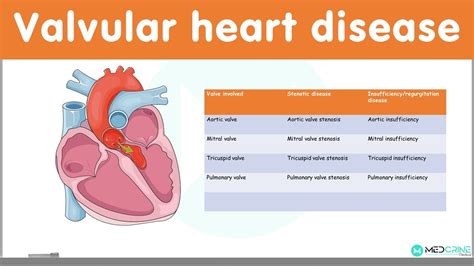 Valvular Heart Diseases Classification Causes Pathophysiology