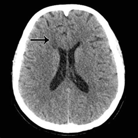 Magnetic Resonance Venography Showing Thrombosis Of Anterior Part Of Download Scientific