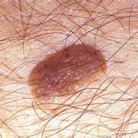 What Are The Treatments For Seborrheic Keratosis Ehow Hot Sex