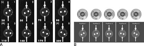 Programmable Csf Shunt Valves Radiographic Identification And