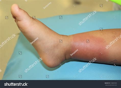 Bacterial Skin Infection On Childs Right Stock Photo 518895595