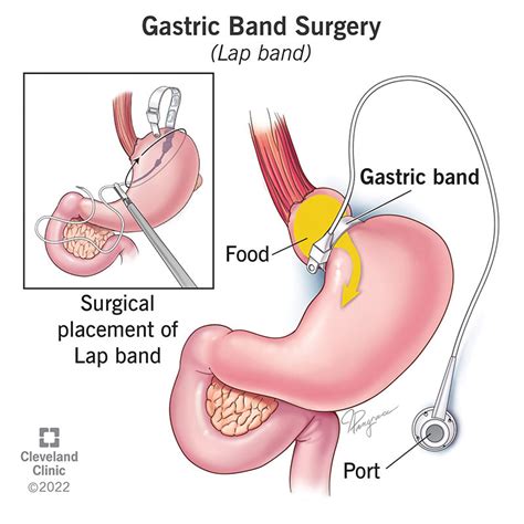 Gastric Band To Laparoscopic Sleeve Gastrectomy Surgery Dr Mario Camelo