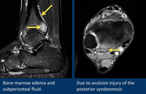 Involved early gray = muscle: The Radiology Assistant : MRI examination of the ankle