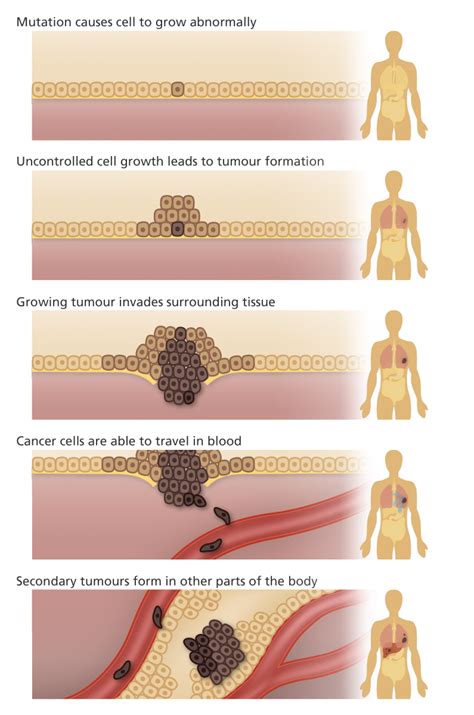 Autolysis n decomposition of dead substrate under the action of removed from living tissue. Is cancer a genetic disease? | Facts | yourgenome.org