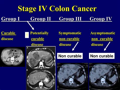 Stage 4 Colon Cancer Survival