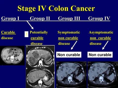 Metastatic colorectal cancer is cancer that has metastasized. PPT - Colon cancer PowerPoint Presentation, free download ...