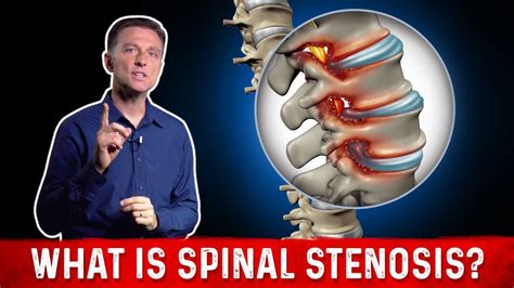 What Is Spinal Stenosis And Its Causes Explained By Dr Berg Youtube