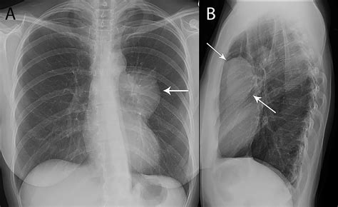 Frontiers Imaging Evaluation Of Thymoma And Thymic Carcinoma