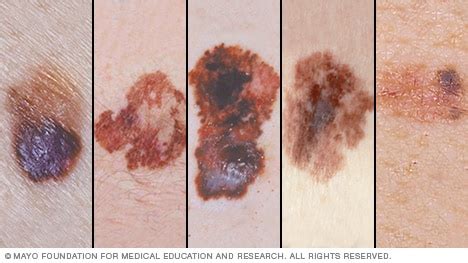 Melanoma Pictures To Help Identify Skin Cancer Mayo Clinic
