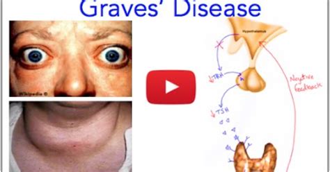 Graves Disease Hyperthyroidism Everything You Need To Know On