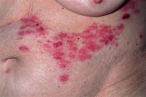 Shingles Rash On Womans Abdomen Photograph By Dr P Marazziscience