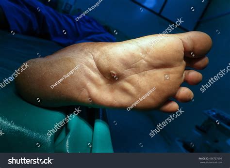 Foot Abscess Wound Pus Edema Operative Stock Photo 436737694 Shutterstock