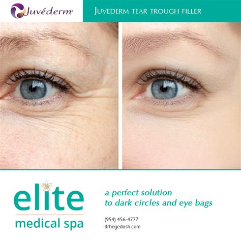 Juvederm Tear Trough Filler A Perfect Solution To Dark Circles And