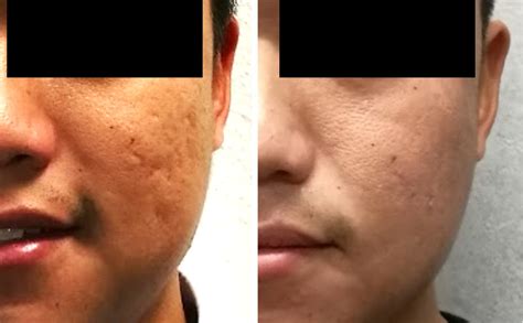 Acne Scar Removal Treatment In Singapore Get Rid Of Them Forever Dr