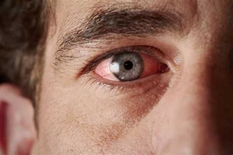 37 Symptoms Of Vitamin B12 Deficiency Pink Eye