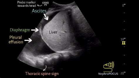 Pleural Effusion The ‘spine Sign Nephropocus