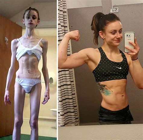 Before After Photos Of People Who Beat Anorexia True Activist