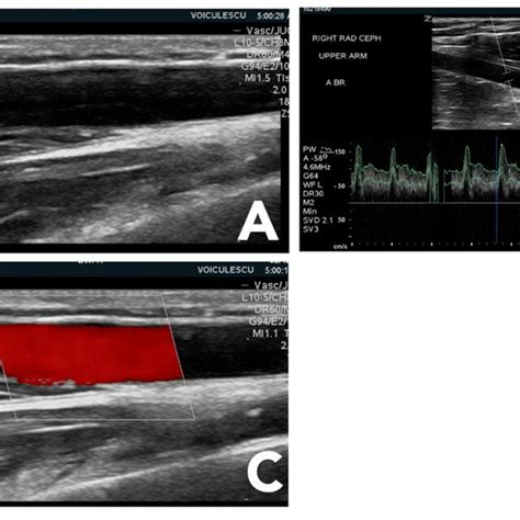 Ultrasound Modes Used For Vascular Access Examination A B Mode