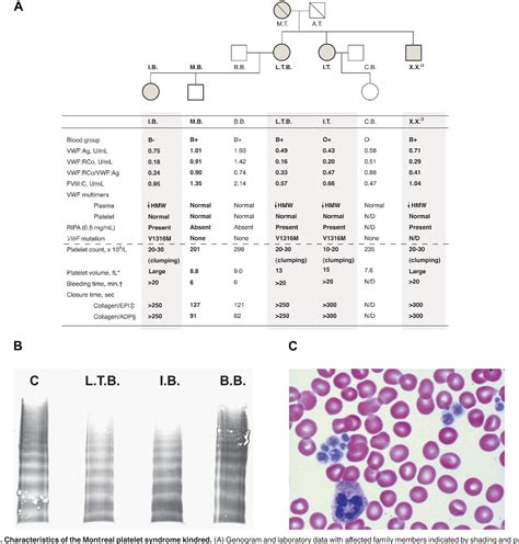 Figure 1 From The Montreal Platelet Syndrome Kindred Has Type 2b Von