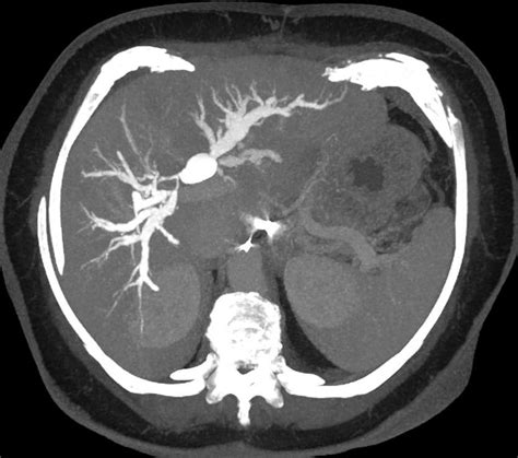 Choledochal Cyst Common Bile Duct With Ercp Liver Case Studies