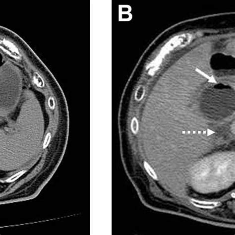On Admission Abdominal Computed Tomography Ct Scan Showed A