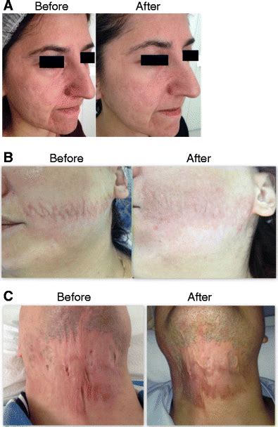 A Atrophic Acne Scar After Four Sessions Of Nonablative Fractional