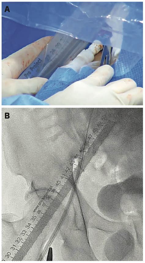 Novel Approach In Percutaneous Large Bore Arteriotomy Closure Manta