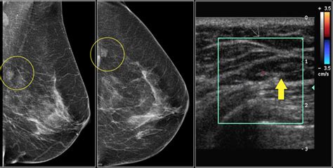 The Radiology Assistant Bi Rads For Mammography And Ultrasound 2013