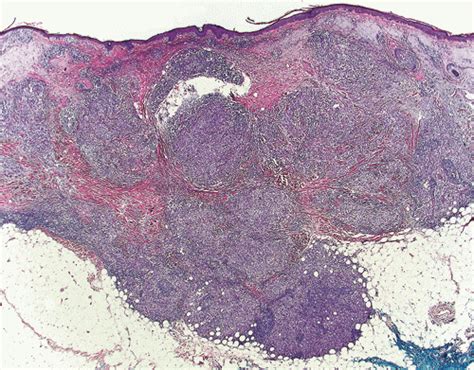 Pseudolymphomatous Reactions With Associated Cutaneous Neoplastic