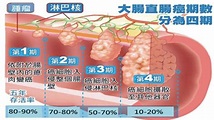 大腸癌台灣癌症發生率第一位 專家淺談腸癌分期、治療方式 | 蕃新聞
