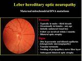Images of Optic Nerve Neuropathy Treatment