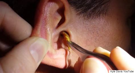 How To Remove Impacted Earwax Specialists Remove Huge Piece Of Earwax
