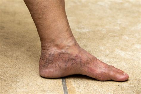 Understanding Varicose Veins In The Feet Vein Institute Of Pinellas