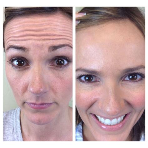 Shekc Jennys Botox Before And After Botoxbeforeandafter Botox Before And After Botox