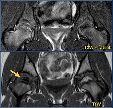 Hip Anatomy Mri Anatomical Charts And Posters