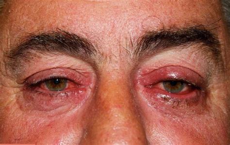 Ocular Rosacea Causes Triggers Symptoms Eye Drops Treatment