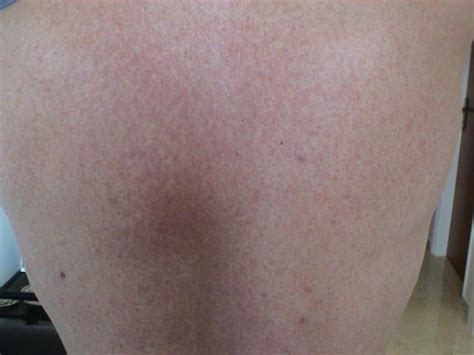 Drug Eruptions Maculopapular Exanthem Due To Clindamycin Picture