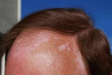 Sunburned Scalp Causes Treatment Products And Prevention Bald And Beards