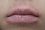 Eczema on the lips: Types, triggers, causes, and treatment