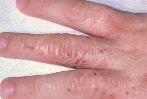 Eczema Rash On A Childs Hand Stock Image M1500063 Science Photo